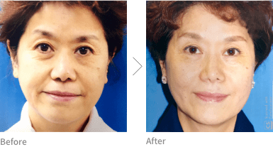 金の糸 施術 Before After イメージ1